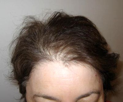 regrow hair follicles naturally